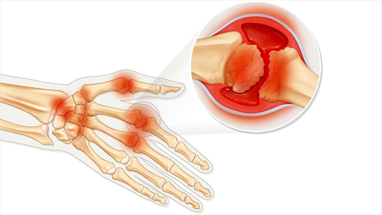 Arthropathy treated with Traugel