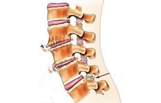 Spinal arthritis is the cause of back pain