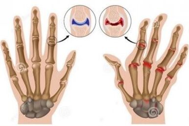 Causes of joint pain in fingers