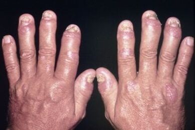 Why are finger joints injured