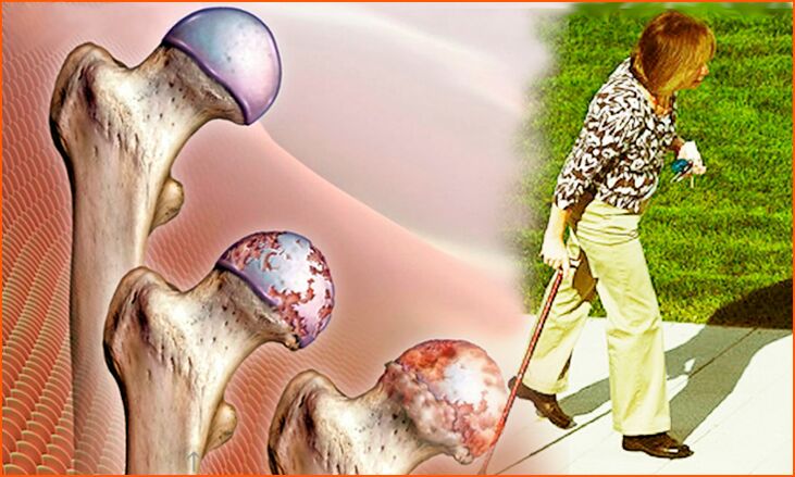 End-stage persistent lameness of hip joint