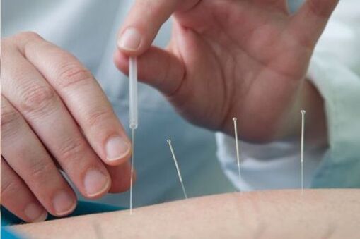 Acupuncture as a treatment for lower back pain caused by osteochondrosis
