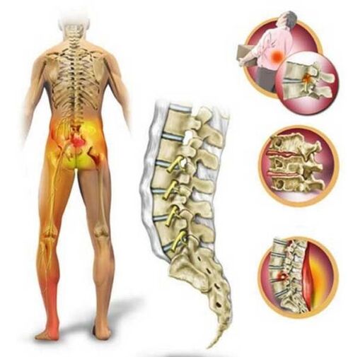 Lumbar osteochondrosis, causing low back pain