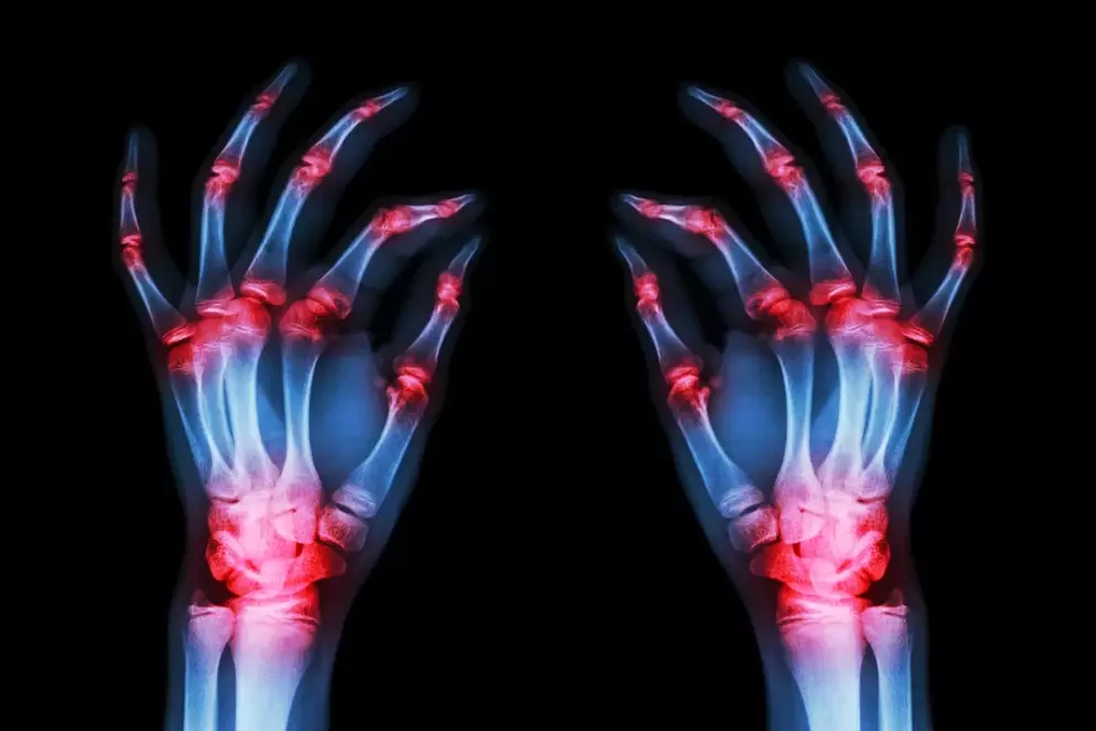 Arthropathy of finger joints