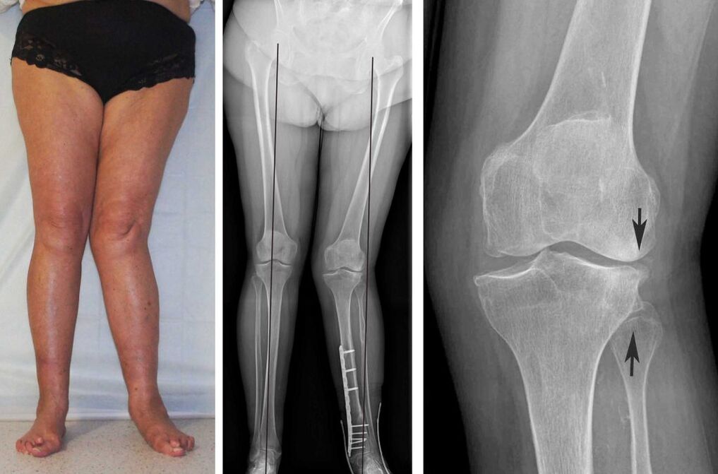 Clinical manifestations of knee osteoarthritis