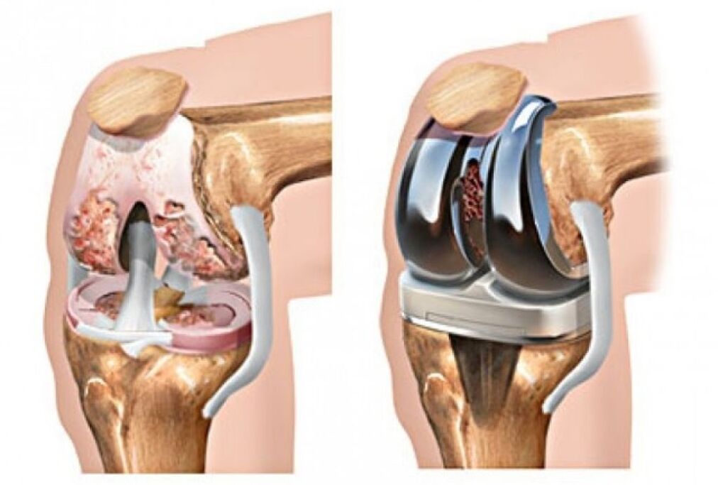 Knee Replacement for Arthropathy