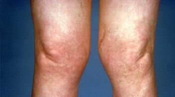 Knee deformity with arthropathy
