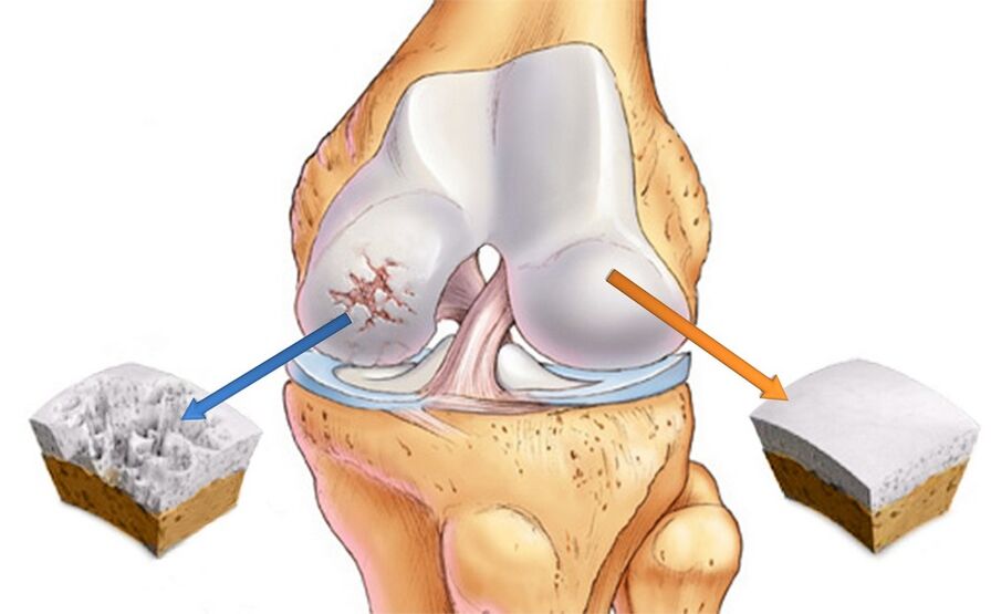 A healthy knee (right) and a knee affected by arthrosis (left)