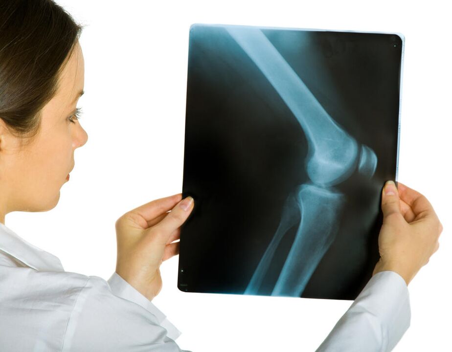 An x-ray of the knee joint will show the presence of joint deformity