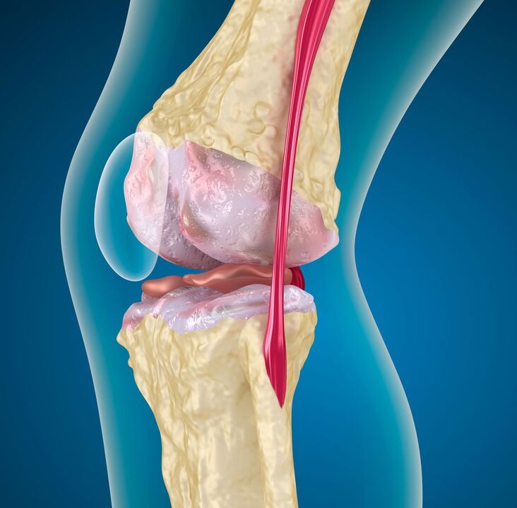 Arthritis of the Knee - A Degenerative Dystrophic Disease